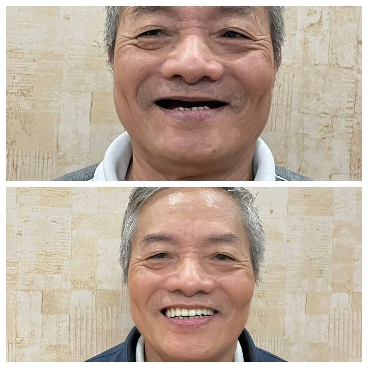 Những Ai Nên trồng răng implant?