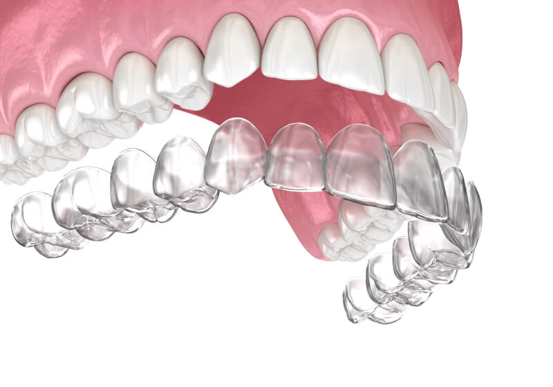 ƯU ĐIỂM NỔI BẬT CỦA PHƯƠNG PHÁP TRỒNG RĂNG IMPLANT