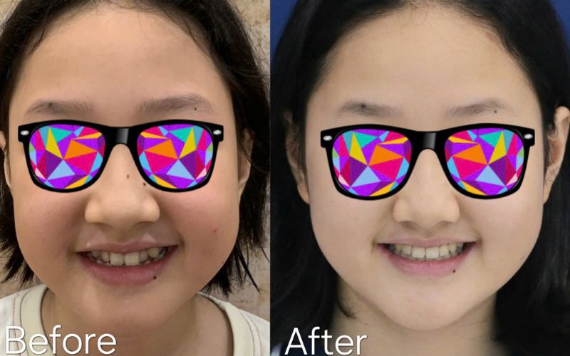 niềng răng trẻ em