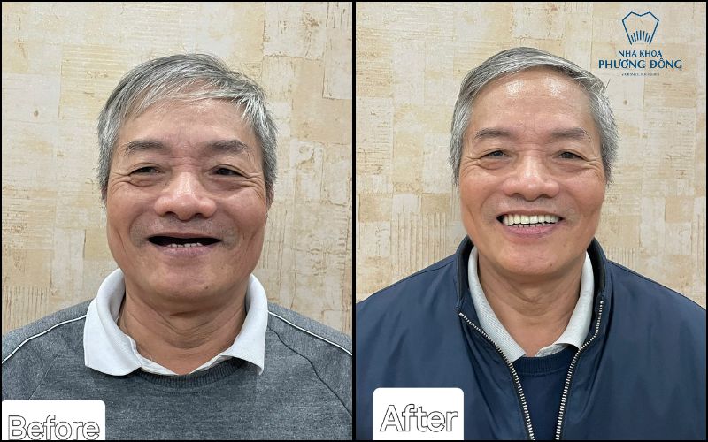 trồng răng implant toàn hàm