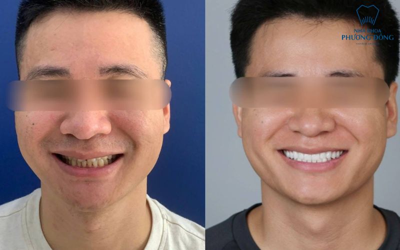 khách hàng của phương đông dán sứ veneer