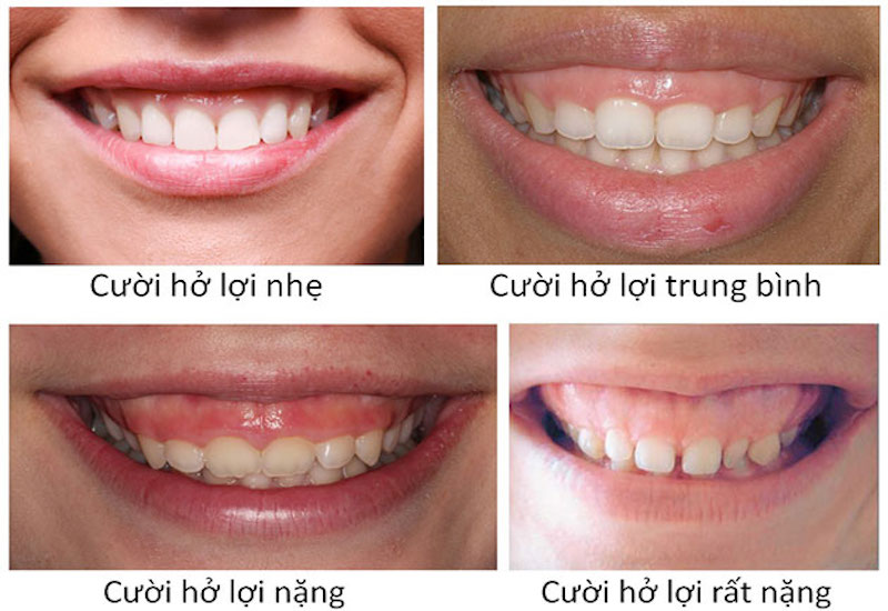 điều trị cười hở lợi