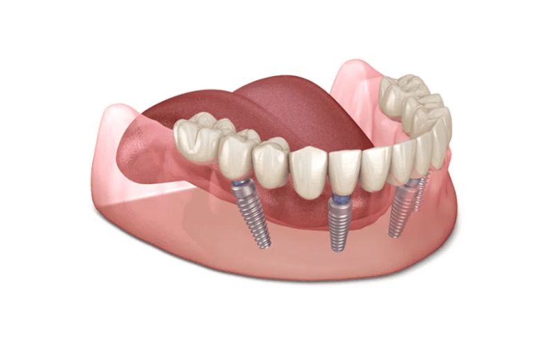 Tại sao nên chọn dịch vụ trồng răng implant vài răng tại nha khoa Phương Đông?