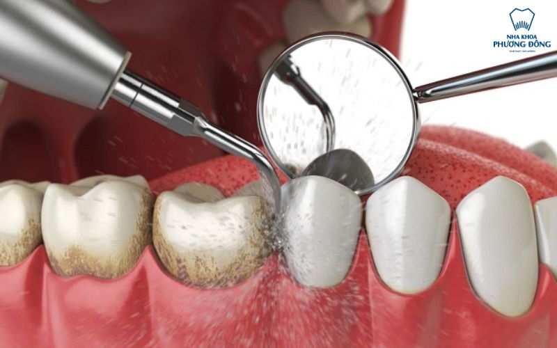 cạo vôi đánh bóng răng