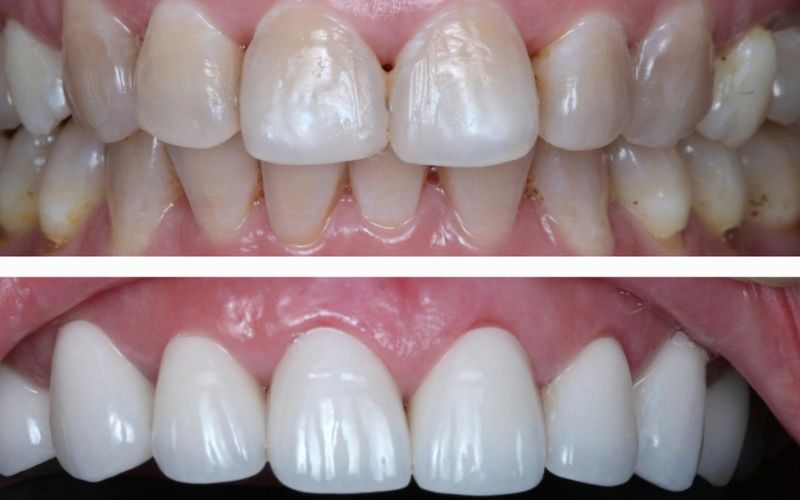 phục hình răng sứ