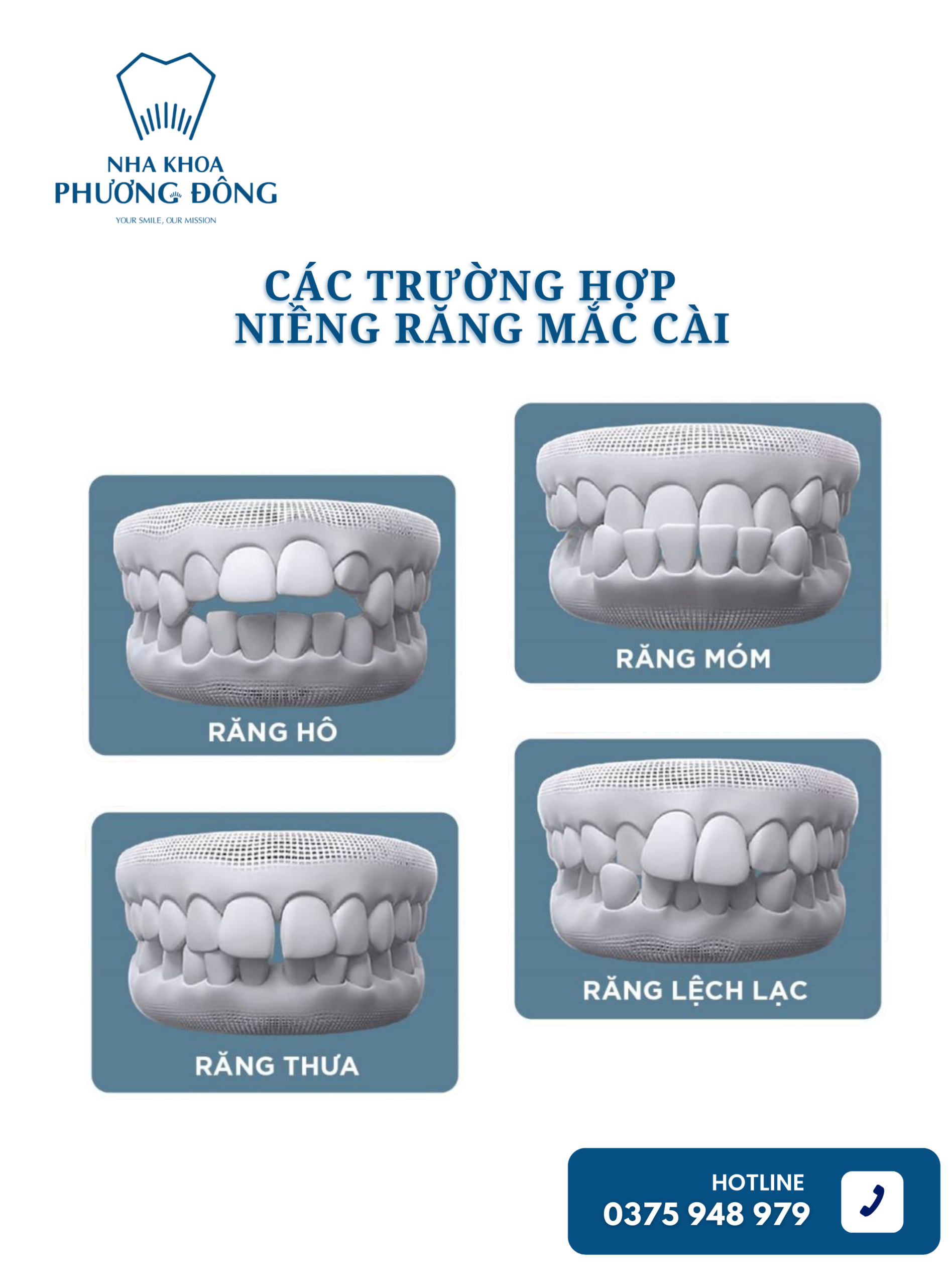 Các trường hợp nên niềng răng mắc cài ?
